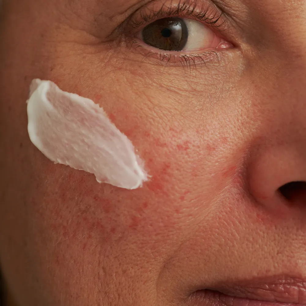 Spezialpflege·Gegen Couperose